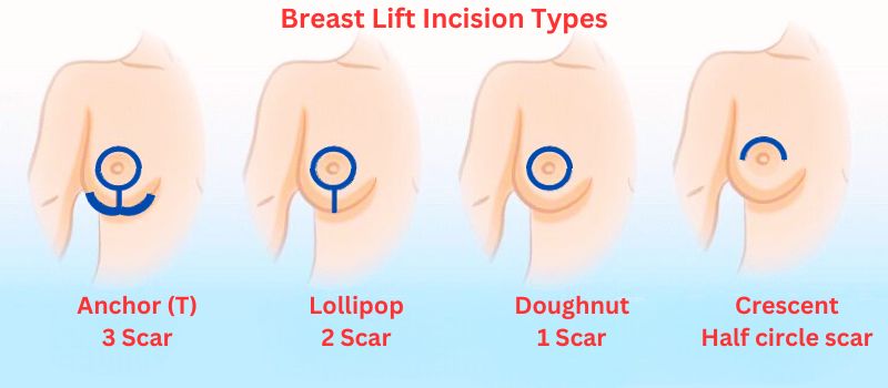 breast-lift-incision-types