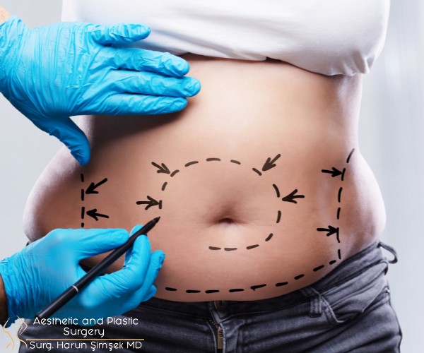 How is Liposuction surgery performed?